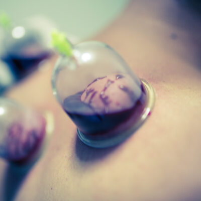 Hijama Therapy